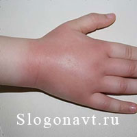 Опухоль